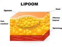 Lipoom / Bron: Designua/Shutterstock.com