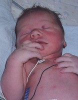 Cyanose bij een pasgeboren baby / Bron: Author: Jules Atkins, RM Supplied by: Brandi Catt, Wikimedia Commons (CC BY-1.0)