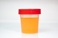 Donkergele urine bij blaasontsteking / Bron: Haryigit/Shutterstock.com