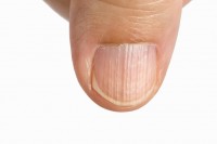Verticale strepen op de nagel / Bron: Toa55/Shutterstock.com