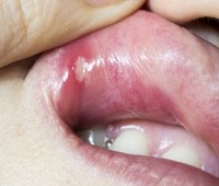 Pijn in de mond door een aft / Bron: Istock.com/FeelPic