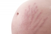 Striae op buik van zwangere vrouw / Bron: Rinelle/Shutterstock.com