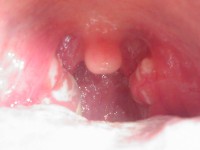 Witte stipjes in de keel door keelontsteking a.g.v. streptokokken / Bron: En:RescueFF, Wikimedia Commons (Publiek domein)