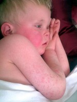 Kleine Rode Stipjes Op Huid: Oorzaak Van Puntbloedinkjes | Mens En  Gezondheid: Aandoeningen