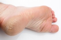 Super Droge voeten: oorzaken, symptomen & behandeling ruwe voeten | Mens IH-92