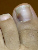 Subunguaal hematoom: bloeduitstorting onder de nagel / Bron: Drgnu23, Wikimedia Commons (CC BY-SA-3.0)