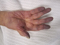 Assimileren Inferieur Verovering Blauwe vingers en handen: oorzaken van blauw-paarse vingers | Mens en  Gezondheid: Aandoeningen