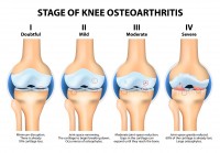 Stadia van artrose in de knie / Bron: Designua/Shutterstock.com