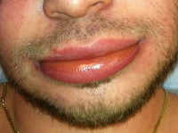 Angio oedeem: zwelling van de lippen / Bron: James Heilman, MD, Wikimedia Commons (CC BY-SA-3.0)