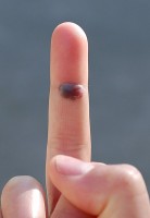 Bloedblaar op een vinger / Bron: Eremitt at English Wikipedia, Wikimedia Commons (Publiek domein)