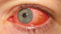 Rood oog / Bron: Marco Mayer, Wikimedia Commons (CC BY-SA-4.0)