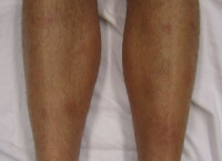Erythema nodosum op de benen / Bron: James Heilman, MD, Wikimedia Commons (CC BY-SA-3.0)