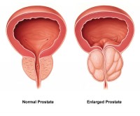 prostatitis és emelkedett leukociták