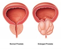 Vergrote prostaat kan bloed in urine bij man veroorzaken / Bron: Akcmdu9, Wikimedia Commons (CC BY-SA-3.0)