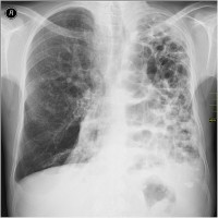 Soms ontstaan reusachtige gaten in de longen van emfyseem patiënten: bulleus emfyseem / Bron: Nevit Dilmen, Wikimedia Commons (CC BY-SA-3.0)