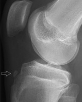 Röntgenfoto van een 15-jarige man, met een oudere avulsiefractuur van de tuberositas tibiae, de knobbel aan de voorkant van je scheenbeen, precies onder je knie / Bron: Mikael Häggström, Wikimedia Commons (CC0)