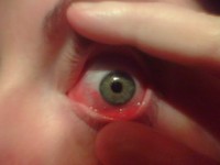 stil Bank Niet verwacht Rode ogen: oorzaken van een rood oog of bloeddoorlopen ogen | Mens en  Gezondheid: Aandoeningen