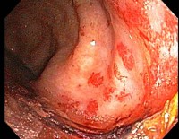 Bestralingsproctitis, ontstaat als gevolg van bestraling (radiotherapie) van een tumor in de buik of het bekken / Bron: Tdvorak, Wikimedia Commons (CC BY-SA-3.0)