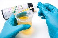Urineonderzoek met behulp van teststrips van troebele urine / Bron: Alexander Raths/Shutterstock