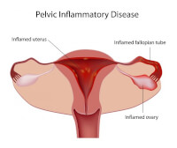Buikpijn na het eten door Pelvic Inflammatory Disease / Bron: Alila Medical Media/Shutterstock