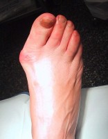 Bunion: rode ontstoken zwelling grote teen / Bron: Cyberprout, Wikimedia Commons (CC BY-SA-1.0)