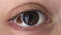 Donkerbruine verkleuringen van het oogwit bij een naevus van Ota / Bron: Luninsky, Wikimedia Commons (CC BY-3.0)