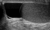 Echo van een spermatocèle (zwart) / Bron: Ultrasound technician at public hospital, Wikimedia Commons (Publiek domein)