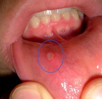  De antibacteriële werking van koriander gaat ontstekingen zoals aften in de mond tegen / Bron: Pfiffner Pascal, Wikimedia Commons (CC BY-SA-3.0)
