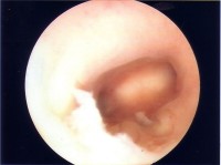 Binnenkant van de baarmoeder met endometrium. Aan het einde van de baarmoederholte zijn aan beide kanten de opening van de eileider. / Bron: DESIDERIUS at Dutch Wikipedia, Wikimedia Commons (CC BY-SA-3.0)
