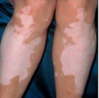 Witte vlekken op de huid door vitiligo / Bron: Charlinb001, Wikimedia Commons (CC BY-SA-3.0)