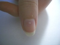 Witte vlekjes op de nagel / Bron: Keitei, Wikimedia Commons (CC BY-2.5)