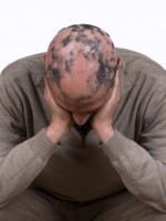 Ernstige vorm van alopecia areata / Bron: Fresnel/Shutterstock.nl