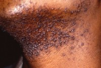 Pseudofolliculitis barbae / Bron: Army Medical Department, Wikimedia Commons (Publiek domein)