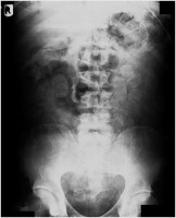 Röntgenfoto van bolletjesslikker / Bron: Lucien Monfils, Wikimedia Commons (CC BY-SA-3.0)