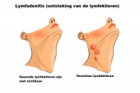 Ontstoken lymfeklieren in de hals / Bron: Artemida-psy/Shutterstock.com