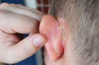 Psoriasis achter het oor / Bron: Claudia Pylinskaya/Shutterstock.com