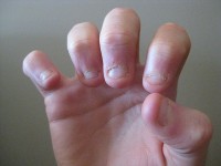 Nagels van een nagelbijtend kind / Bron: Aboghetto, Wikimedia Commons (CC BY-SA-3.0)
