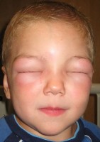 Angio oedeem gezicht: zwelling van de oogleden / Bron: James Heilman, MD, Wikimedia Commons (CC BY-SA-3.0)