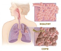 COPD in vergelijking met een gezonde long (healthy) / Bron: Publiek domein, Wikimedia Commons (PD)