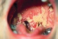 Schimmelinfectie in de mond geeft roomwitte plekjes / Bron: CDC, Wikimedia Commons (Publiek domein)