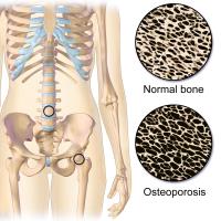 Osteoporose / Bron: Blausen.com staff, Wikimedia Commons (CC BY-SA-4.0)