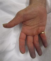 Werkwijze Diversen Botsing Blauwe vingers en handen: oorzaken van blauw-paarse vingers | Mens en  Gezondheid: Aandoeningen