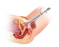 Cystoscopie bij blaaskanker / Bron: Alexilusmedical/Shutterstock