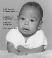 De kenmerken en symptomen van FAS bij een baby/kind / Bron: Teresa Kellerman, Wikimedia Commons (CC BY-SA-3.0)