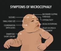 Microcephalie bij een baby door zika / Bron: Beth.herlin, Wikimedia Commons (CC BY-SA-4.0)