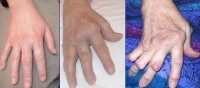 Vergroeiingen t.g.v. reumatoïde artritis / Bron: Publiek domein, Wikimedia Commons (PD)
