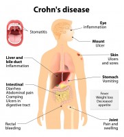 Mogelijke klachten en symptomen bij de ziekte van Crohn / Bron: Designua/Shutterstock.com