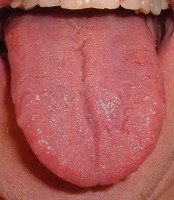Een gezonde tong is roze tot rood van kleur / Bron: ArnoldReinhold, Wikimedia Commons (CC BY-SA-3.0)