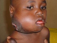 Zeven jaar oude Nigeriaanse jongen met een zwelling in de kaak die reeds enige maanden aanwezig is als gevolg van een Burkitt-lymfoom  / Bron: Mike Blyth, Wikimedia Commons (CC BY-SA-2.5)