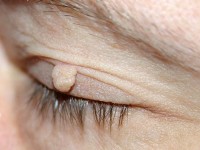Skin tag op ooglid / Bron: Oliver Riesen, Wikimedia Commons (Publiek domein)
